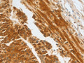 The image on the left is immunohistochemistry of paraffin-embedded Human liver cancer tissue using CSB-PA587680(CFHR1 Antibody) at dilution 1/30, on the right is treated with fusion protein. (Original magnification: ×200)