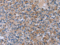 The image on the left is immunohistochemistry of paraffin-embedded Human prostate cancer tissue using CSB-PA588101(HSD3B2 Antibody) at dilution 1/50, on the right is treated with fusion protein. (Original magnification: ×200)