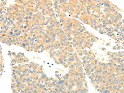 The image on the left is immunohistochemistry of paraffin-embedded Human liver cancer tissue using CSB-PA588368(SOX2 Antibody) at dilution 1/15, on the right is treated with fusion protein. (Original magnification: ×200)