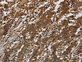 The image on the left is immunohistochemistry of paraffin-embedded Human liver cancer tissue using CSB-PA588701(ITGB7 Antibody) at dilution 1/40, on the right is treated with synthetic peptide. (Original magnification: ×200)