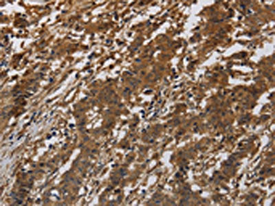 The image on the left is immunohistochemistry of paraffin-embedded Human liver cancer tissue using CSB-PA588701(ITGB7 Antibody) at dilution 1/40, on the right is treated with synthetic peptide. (Original magnification: ×200)