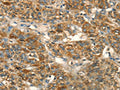 The image on the left is immunohistochemistry of paraffin-embedded Human liver cancer tissue using CSB-PA588793(HSD17B8 Antibody) at dilution 1/55, on the right is treated with fusion protein. (Original magnification: ×200)