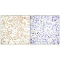 Immunohistochemical analysis of paraffin-embedded human breast carcinoma tissue using Fra-2 antibody.