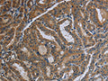 The image on the left is immunohistochemistry of paraffin-embedded Human thyroid cancer tissue using CSB-PA589232(FAAH Antibody) at dilution 1/40, on the right is treated with fusion protein. (Original magnification: ×200)