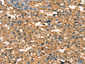 The image on the left is immunohistochemistry of paraffin-embedded Human thyroid cancer tissue using CSB-PA589353(APC Antibody) at dilution 1/25, on the right is treated with synthetic peptide. (Original magnification: ×200)