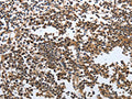 The image on the left is immunohistochemistry of paraffin-embedded Human tonsil tissue using CSB-PA589405(MSH6 Antibody) at dilution 1/20, on the right is treated with fusion protein. (Original magnification: ×200)