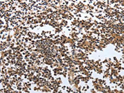 The image on the left is immunohistochemistry of paraffin-embedded Human tonsil tissue using CSB-PA589405(MSH6 Antibody) at dilution 1/20, on the right is treated with fusion protein. (Original magnification: ×200)
