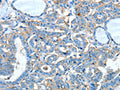 The image on the left is immunohistochemistry of paraffin-embedded Human thyroid cancer tissue using CSB-PA589884(ADRA1A Antibody) at dilution 1/60, on the right is treated with synthetic peptide. (Original magnification: ×200)