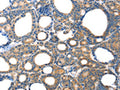 The image on the left is immunohistochemistry of paraffin-embedded Human thyroid cancer tissue using CSB-PA590597(TAC1 Antibody) at dilution 1/20, on the right is treated with fusion protein. (Original magnification: ×200)