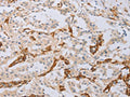 The image on the left is immunohistochemistry of paraffin-embedded Human thyroid cancer tissue using CSB-PA590716(MYL6 Antibody) at dilution 1/40, on the right is treated with fusion protein. (Original magnification: ×200)
