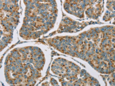 The image on the left is immunohistochemistry of paraffin-embedded Human breast cancer tissue using CSB-PA591028(CYP11B1 Antibody) at dilution 1/25, on the right is treated with fusion protein. (Original magnification: ×200)