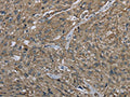 The image on the left is immunohistochemistry of paraffin-embedded Human esophagus cancer tissue using CSB-PA591518(CLPS Antibody) at dilution 1/40, on the right is treated with fusion protein. (Original magnification: ×200)