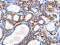 The image on the left is immunohistochemistry of paraffin-embedded Human thyroid cancer tissue using CSB-PA591787(IGSF6 Antibody) at dilution 1/10, on the right is treated with fusion protein. (Original magnification: ×200)