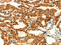 The image on the left is immunohistochemistry of paraffin-embedded Human thyroid cancer tissue using CSB-PA592293(DIABLO Antibody) at dilution 1/70, on the right is treated with fusion protein. (Original magnification: ×200)