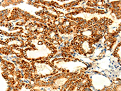 The image on the left is immunohistochemistry of paraffin-embedded Human thyroid cancer tissue using CSB-PA592293(DIABLO Antibody) at dilution 1/70, on the right is treated with fusion protein. (Original magnification: ×200)