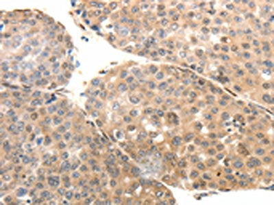 The image on the left is immunohistochemistry of paraffin-embedded Human liver cancer tissue using CSB-PA592388(SYT7 Antibody) at dilution 1/15, on the right is treated with fusion protein. (Original magnification: ×200)
