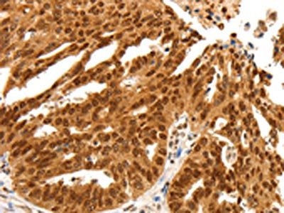 The image on the left is immunohistochemistry of paraffin-embedded Human ovarian cancer tissue using CSB-PA592469(PDCD6 Antibody) at dilution 1/25, on the right is treated with fusion protein. (Original magnification: ×200)