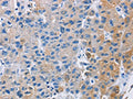 The image on the left is immunohistochemistry of paraffin-embedded Human liver cancer tissue using CSB-PA592611(CARD14 Antibody) at dilution 1/30, on the right is treated with fusion protein. (Original magnification: ×200)