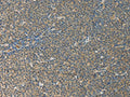 The image on the left is immunohistochemistry of paraffin-embedded Human lymphoma tissue using CSB-PA592707(IL27 Antibody) at dilution 1/10, on the right is treated with fusion protein. (Original magnification: ×200)