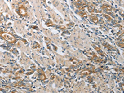 The image on the left is immunohistochemistry of paraffin-embedded Human gastic cancer tissue using CSB-PA592744(CST3 Antibody) at dilution 1/50, on the right is treated with synthetic peptide. (Original magnification: ×200)