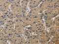 The image on the left is immunohistochemistry of paraffin-embedded Human liver cancer tissue using CSB-PA593332(TBXAS1 Antibody) at dilution 1/30, on the right is treated with fusion protein. (Original magnification: ×200)