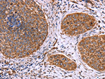The image on the left is immunohistochemistry of paraffin-embedded Human cervical cancer tissue using CSB-PA593413(CLUAP1 Antibody) at dilution 1/50, on the right is treated with fusion protein. (Original magnification: ×200)