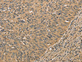 The image on the left is immunohistochemistry of paraffin-embedded Human cervical cancer tissue using CSB-PA593478(PRDM14 Antibody) at dilution 1/30, on the right is treated with fusion protein. (Original magnification: ×200)