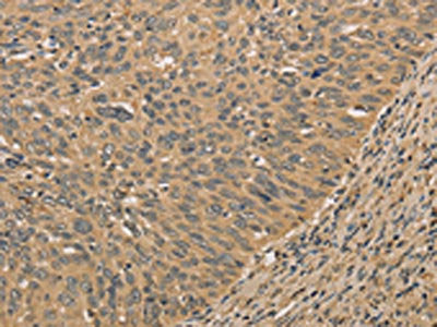 The image on the left is immunohistochemistry of paraffin-embedded Human cervical cancer tissue using CSB-PA593478(PRDM14 Antibody) at dilution 1/30, on the right is treated with fusion protein. (Original magnification: ×200)