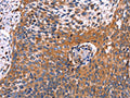 The image on the left is immunohistochemistry of paraffin-embedded Human cervical cancer tissue using CSB-PA593723(RDX Antibody) at dilution 1/60, on the right is treated with fusion protein. (Original magnification: ×200)