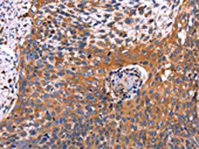 The image on the left is immunohistochemistry of paraffin-embedded Human cervical cancer tissue using CSB-PA593723(RDX Antibody) at dilution 1/60, on the right is treated with fusion protein. (Original magnification: ×200)