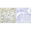 Immunohistochemistry analysis of paraffin-embedded human liver carcinoma tissue using DNMT3B antibody.