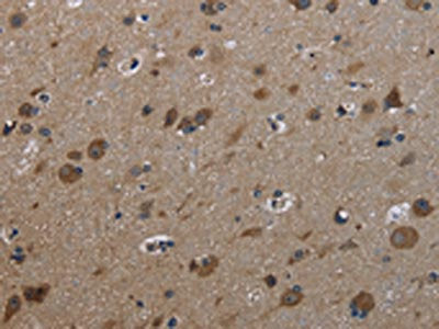 The image on the left is immunohistochemistry of paraffin-embedded Human brain tissue using CSB-PA593946(GSTA3 Antibody) at dilution 1/30, on the right is treated with fusion protein. (Original magnification: ×200)