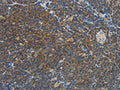 The image on the left is immunohistochemistry of paraffin-embedded Human Lymphoma tissue using CSB-PA594088(VTCN1 Antibody) at dilution 1/30, on the right is treated with fusion protein. (Original magnification: ×200)