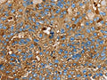 The image on the left is immunohistochemistry of paraffin-embedded Human breast cancer tissue using CSB-PA594413(LGALS3BP Antibody) at dilution 1/25, on the right is treated with fusion protein. (Original magnification: ×200)