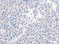 The image on the left is immunohistochemistry of paraffin-embedded Human liver cancer tissue using CSB-PA594444(GCK Antibody) at dilution 1/20, on the right is treated with synthetic peptide. (Original magnification: ×200)