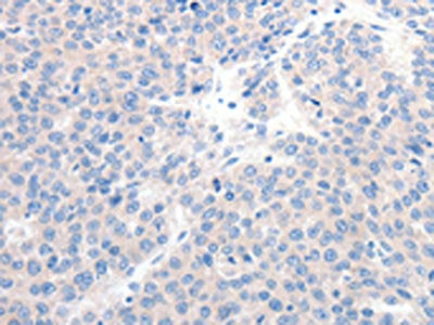 The image on the left is immunohistochemistry of paraffin-embedded Human liver cancer tissue using CSB-PA594444(GCK Antibody) at dilution 1/20, on the right is treated with synthetic peptide. (Original magnification: ×200)