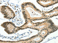 The image on the left is immunohistochemistry of paraffin-embedded Human colon cancer tissue using CSB-PA594692(BCAS2 Antibody) at dilution 1/50, on the right is treated with fusion protein. (Original magnification: ×200)