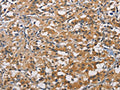 The image on the left is immunohistochemistry of paraffin-embedded Human thyroid cancer tissue using CSB-PA594945(PIKFYVE Antibody) at dilution 1/50, on the right is treated with fusion protein. (Original magnification: ×200)