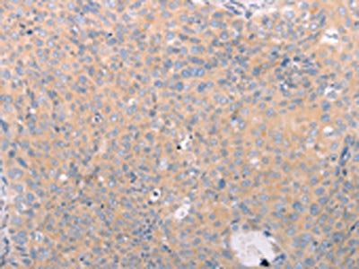 The image on the left is immunohistochemistry of paraffin-embedded Human cervical cancer tissue using CSB-PA595084(ABCF3 Antibody) at dilution 1/30, on the right is treated with fusion protein. (Original magnification: ×200)