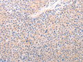 The image on the left is immunohistochemistry of paraffin-embedded Human liver cancer tissue using CSB-PA595124(ACO1 Antibody) at dilution 1/50, on the right is treated with synthetic peptide. (Original magnification: ×200)