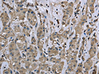 The image on the left is immunohistochemistry of paraffin-embedded Human breast cancer tissue using CSB-PA595808(MYL12B Antibody) at dilution 1/25, on the right is treated with fusion protein. (Original magnification: ×200)