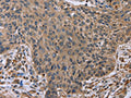The image on the left is immunohistochemistry of paraffin-embedded Human lung cancer tissue using CSB-PA595868(EDA Antibody) at dilution 1/50, on the right is treated with fusion protein. (Original magnification: ×200)
