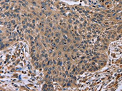 The image on the left is immunohistochemistry of paraffin-embedded Human lung cancer tissue using CSB-PA595868(EDA Antibody) at dilution 1/50, on the right is treated with fusion protein. (Original magnification: ×200)