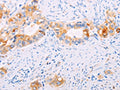 The image on the left is immunohistochemistry of paraffin-embedded Human cervical cancer tissue using CSB-PA596121(TGM2 Antibody) at dilution 1/15, on the right is treated with fusion protein. (Original magnification: ×200)