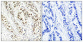Immunohistochemical analysis of paraffin-embedded human breast carcinoma tissue using BRCA1(Phospho-Ser1524) Antibody(left) or the same antibody preincubated with blocking peptide(right).