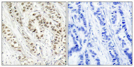 Immunohistochemical analysis of paraffin-embedded human breast carcinoma tissue using BRCA1(Phospho-Ser1524) Antibody(left) or the same antibody preincubated with blocking peptide(right).