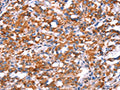 The image on the left is immunohistochemistry of paraffin-embedded Human thyroid cancer tissue using CSB-PA596695(GH1 Antibody) at dilution 1/40, on the right is treated with synthetic peptide. (Original magnification: ×200)