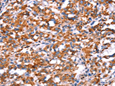 The image on the left is immunohistochemistry of paraffin-embedded Human thyroid cancer tissue using CSB-PA596695(GH1 Antibody) at dilution 1/40, on the right is treated with synthetic peptide. (Original magnification: ×200)