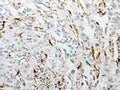 The image on the left is immunohistochemistry of paraffin-embedded Human esophagus cancer tissue using CSB-PA596700(F13A1 Antibody) at dilution 1/25, on the right is treated with fusion protein. (Original magnification: ×200)