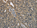 The image on the left is immunohistochemistry of paraffin-embedded Human ovarian cancer tissue using CSB-PA596780(PRDX6 Antibody) at dilution 1/25, on the right is treated with fusion protein. (Original magnification: ×200)